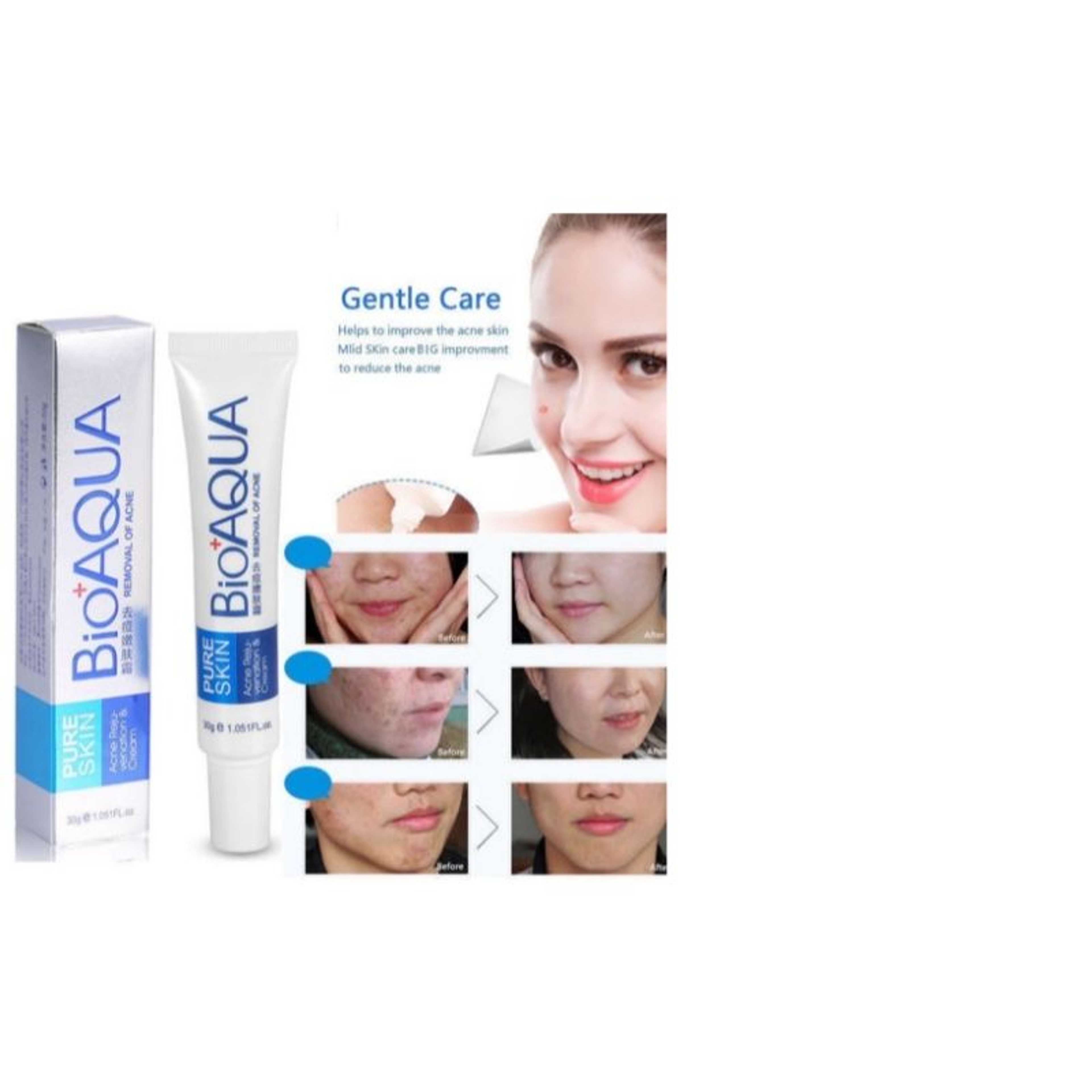 REMOVAL OF ACNE / ACNE REJUVENATION & CREAM